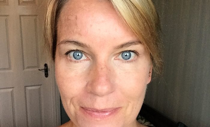 A Botox update and microneedling
